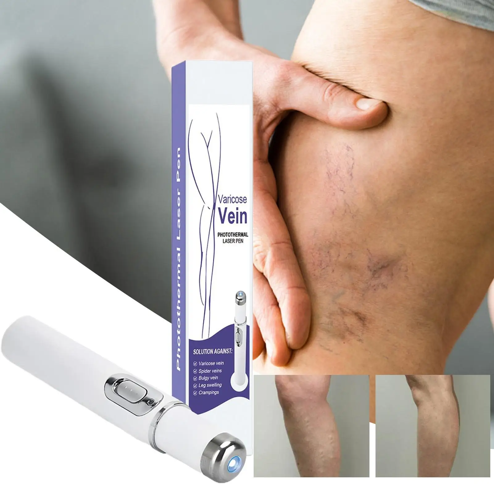 Spider Vein Removal Pen Skin Discomfort Remover Tool Vein Care Pen Improve varicose vein Daily Relief Salon phototherapy nursing