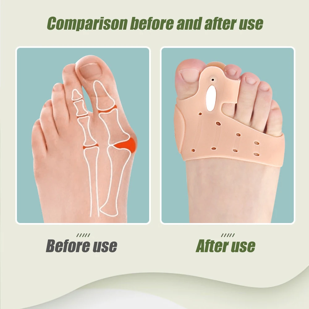 Breathable Toe Separator, Metatarsal Pads, Toe Straightener for Bunion, Hammer Toes, Soft, 1 Pair