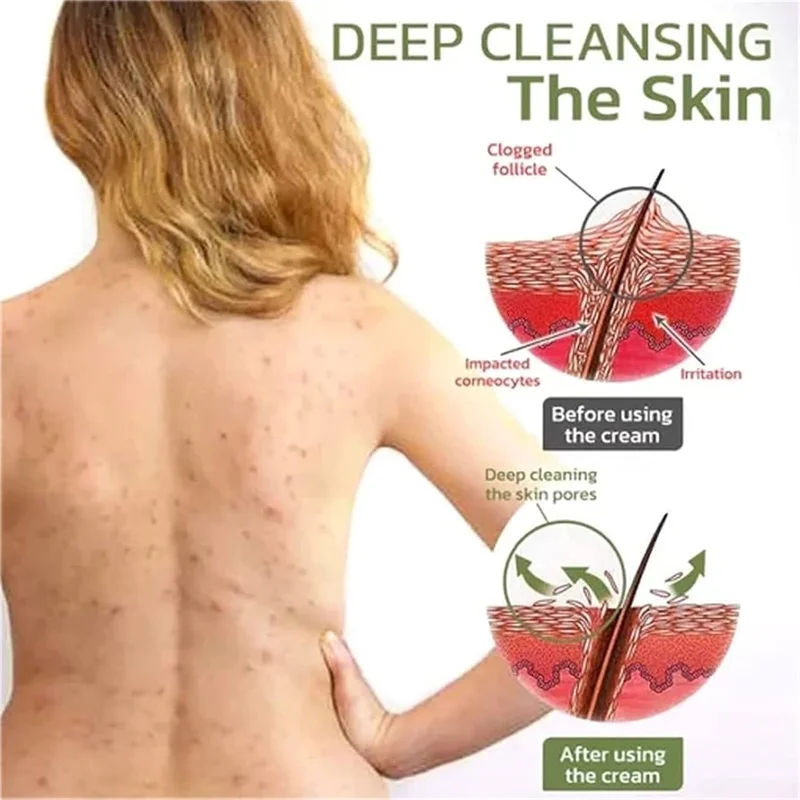 Body Acne Removal Cream Treatment Face Butt Back Acne Marks Smooth Repair Chicken Skin Cream Moisturizing Whitening Skin Care - view 4