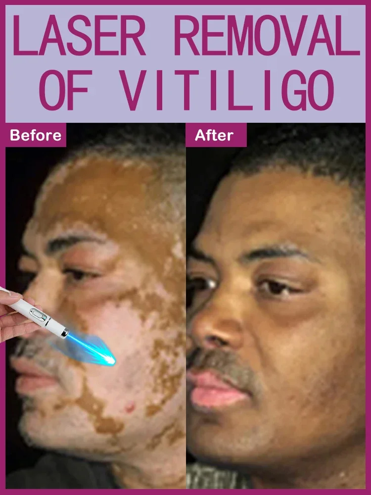 

Vitiligo быстро улучшает белые пятна