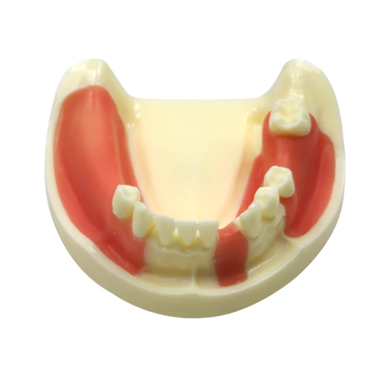 Dental Restoration Model Gingiva with Missing Teeth Lower Jaw Dentist Student Learning Practice Model Dental Materials