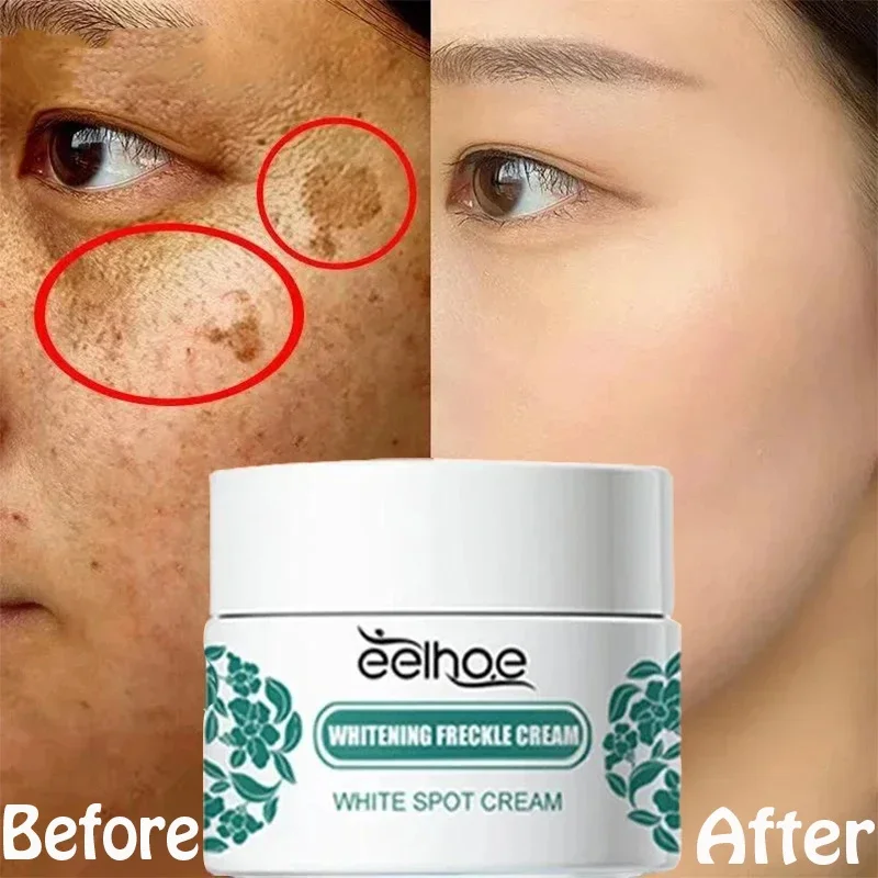 

Effective Whitening Freckle Niacinamide Cream Remove Dark Spots Anti Freckle Cream Fade Pigmentation Melasma Creams Skin Care