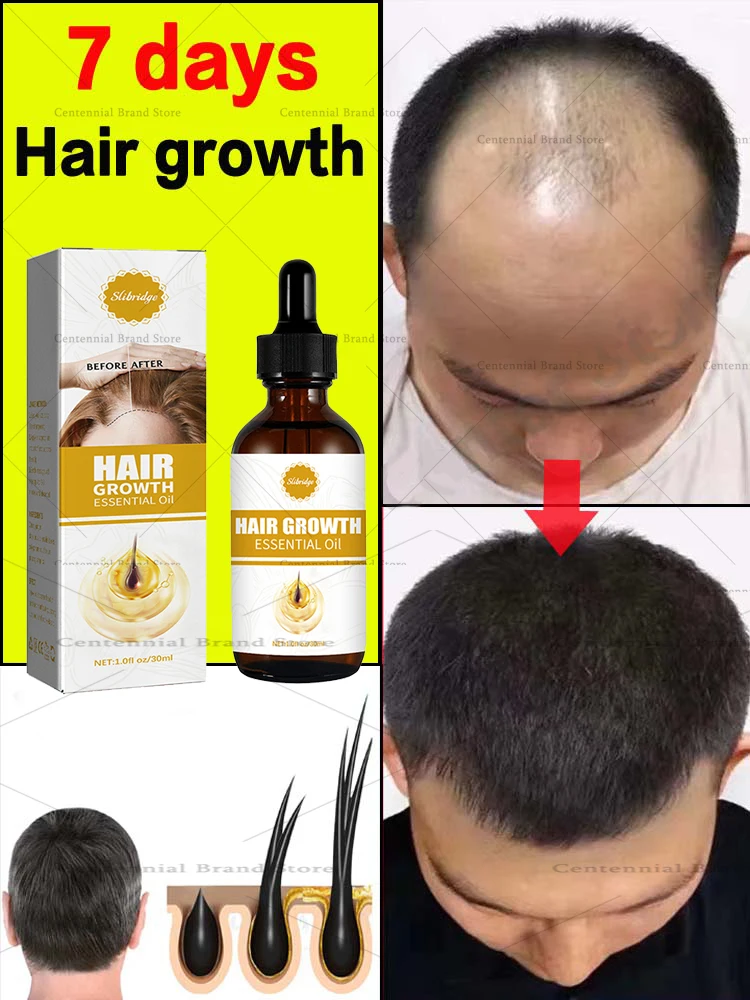 

Fast Hair Growth Hair Growth Oil Effective Repair Baldness Postpartum Hair Loss Hereditary Hair Loss Seborrheic Hair Loss