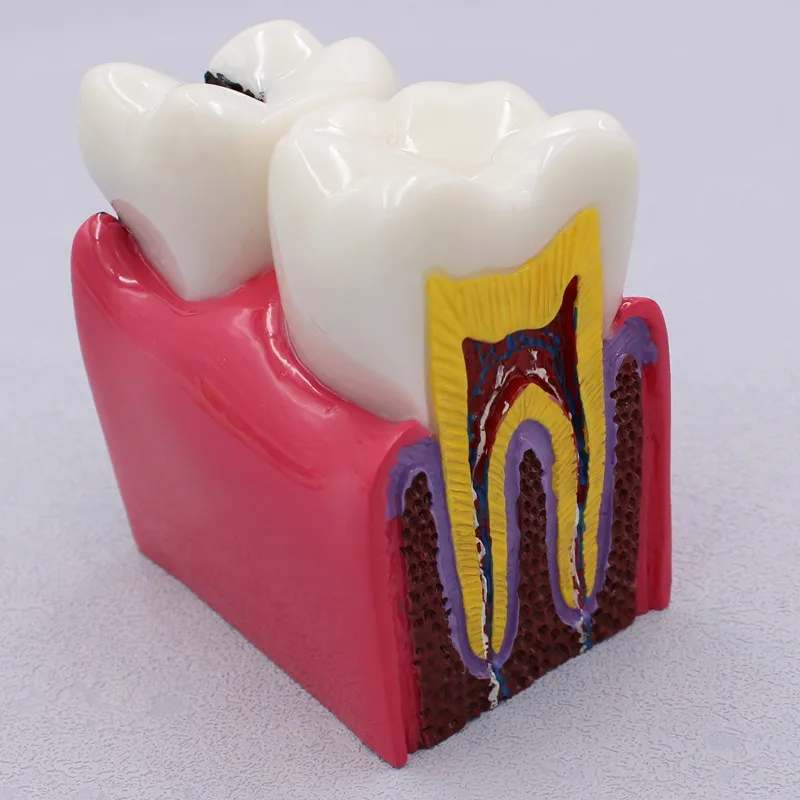 Modelo dental dos dentes do laboratório para o dentista, materiais do estudo para estudar e pesquisar, 6 vezes cárie, 1PC