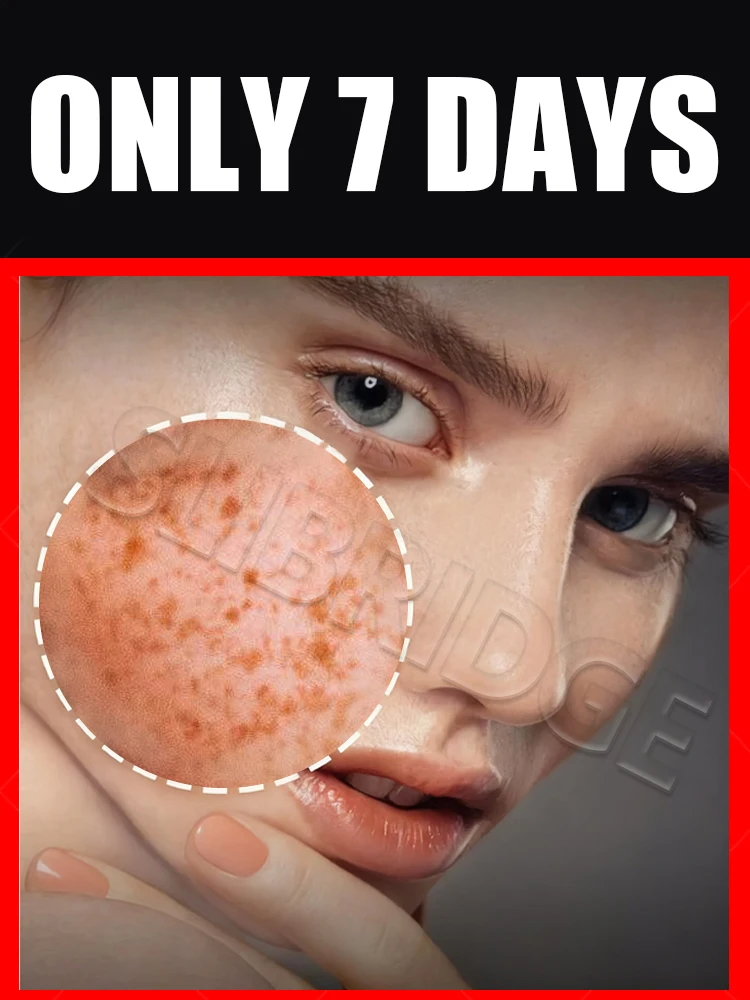 

2025 New Upgrade Farewell to Melasma Dark Spots care Tool Skin Lightening Solve