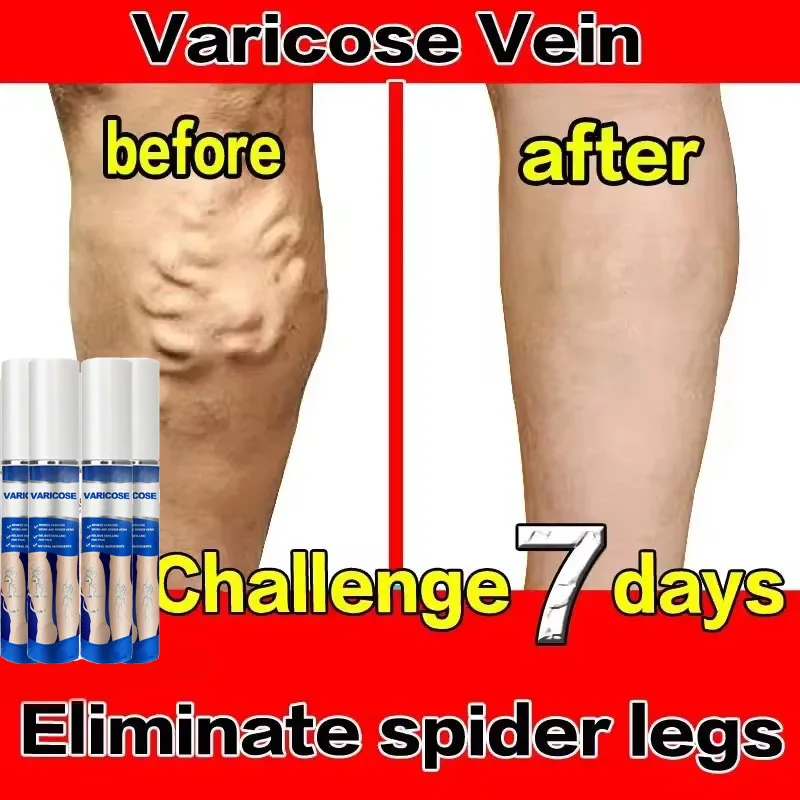 الجيل الثالث يزيل التهاب الأوعية الدموية والتهاب الوريد ويخفف آلام الساق العنكبوتية ومؤشر العلاج بالليزر للدوالي