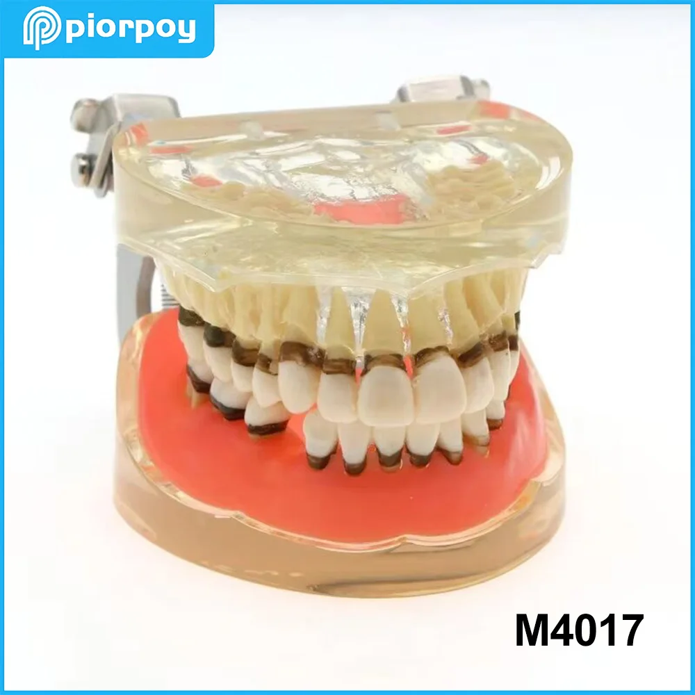PIORPOYDental Teaching Model Pathological Periodontal Disease Study Teeth Mold Dentistry Education Students Training Tools M4017
