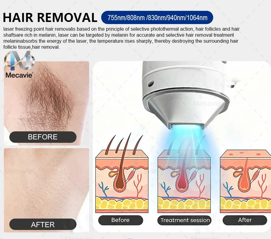 2026 Professional 5000W Four-Wave Diode Laser Hair Removal Device Suitable for Beauty Salons