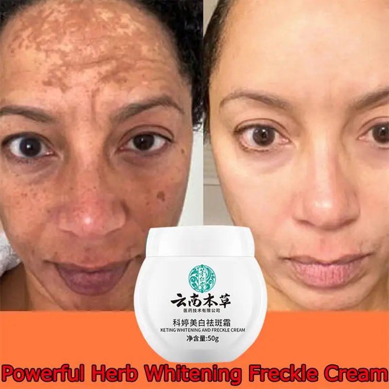 Dark Spot Corrector Skin Whitening Fade Cream Lighten Blemish Removal Serum Reduces Freckles Melasma Sun Spot Brighten Skin Care