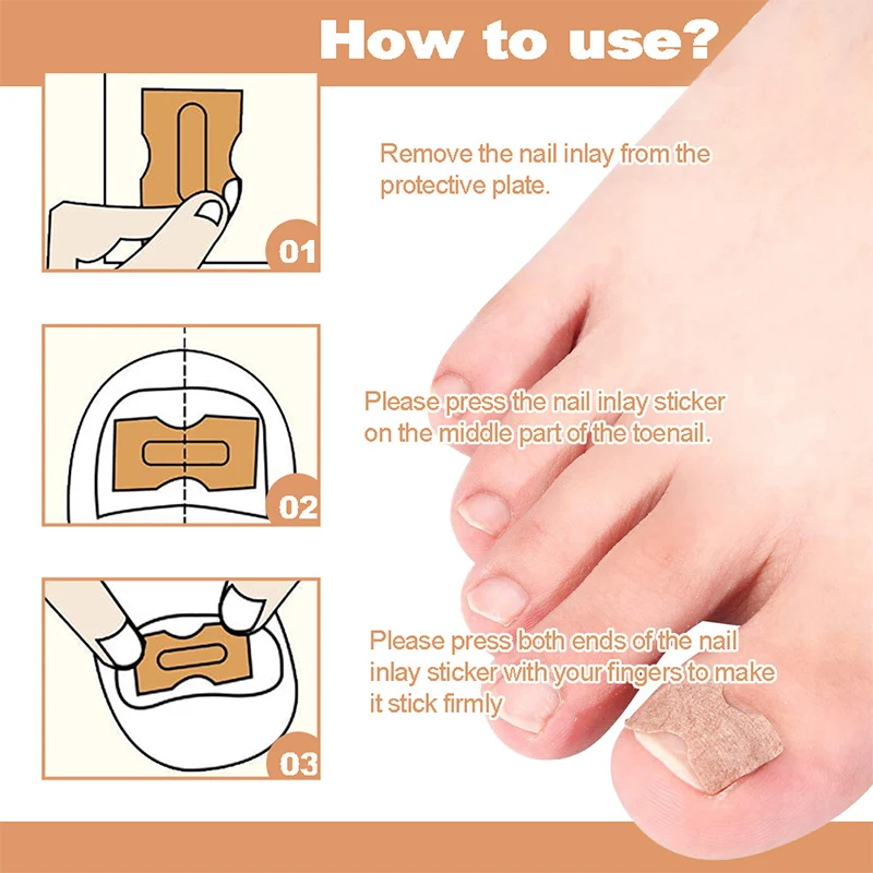 ملصقات تصحيح الأظافر الناشئة ، رقع مصحح أظافر القدم ، علاج البارونيشيا ، أداة العناية بالأظافر ، 60: 50