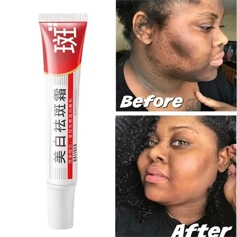 

Whitening Freckles Cream Effective Remove Melasma Dark Spots Fade Pigmentation Moisturize Brighten Korean Face Skin Care Product