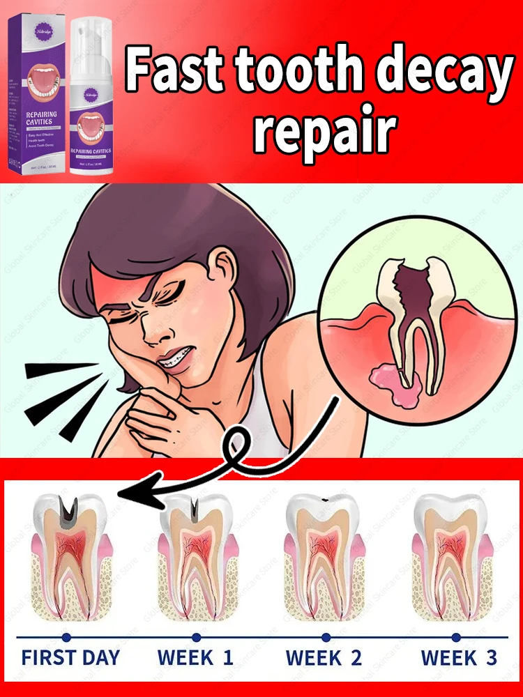 decay Tooth Repair Repairing Cavities Protect Anti caries