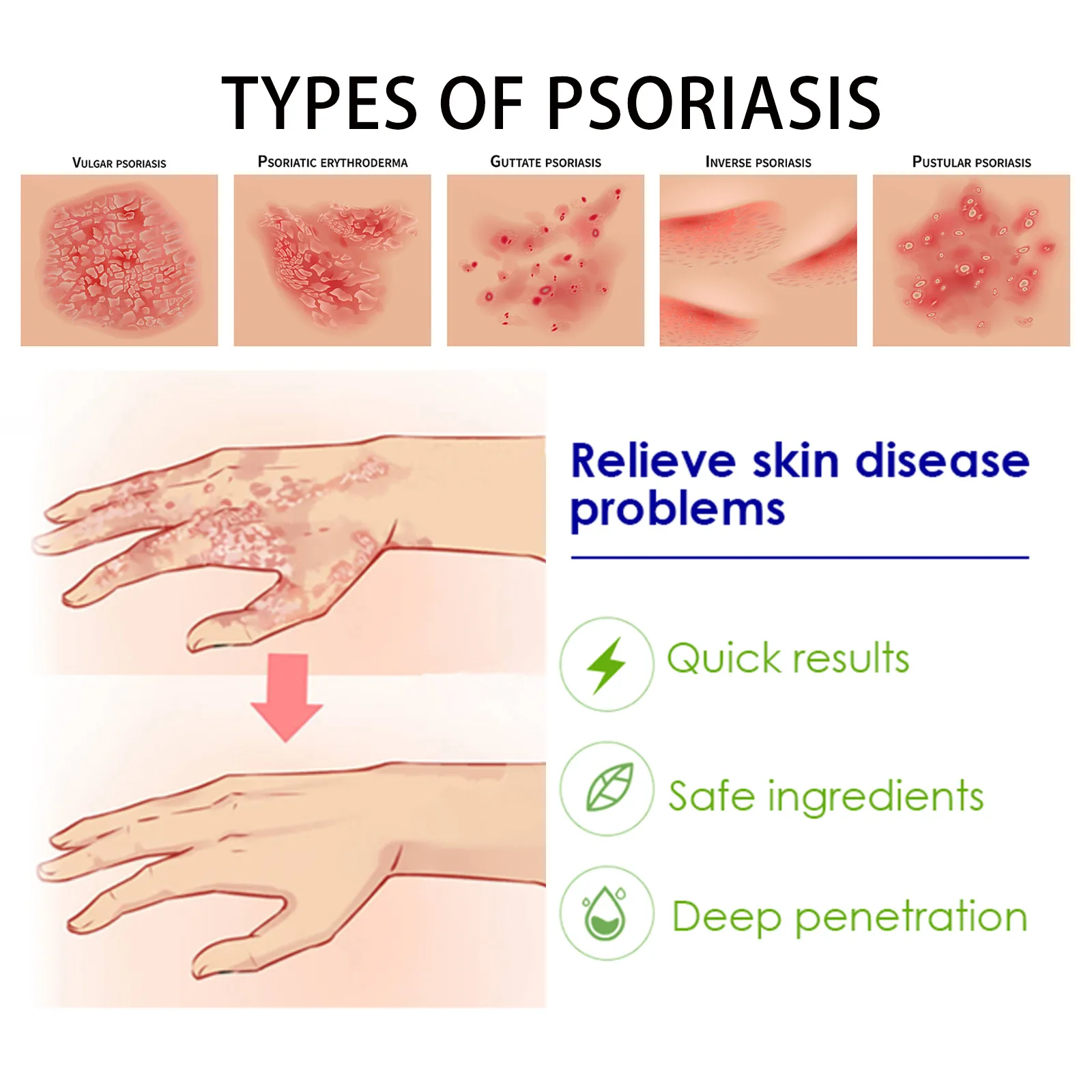 Psoriasis Repair Chinese Herbal Ointment Bacteriostasis Antipruritic Psoriasi Eczema Dermatitis Rash Treatment Skin Care Cream