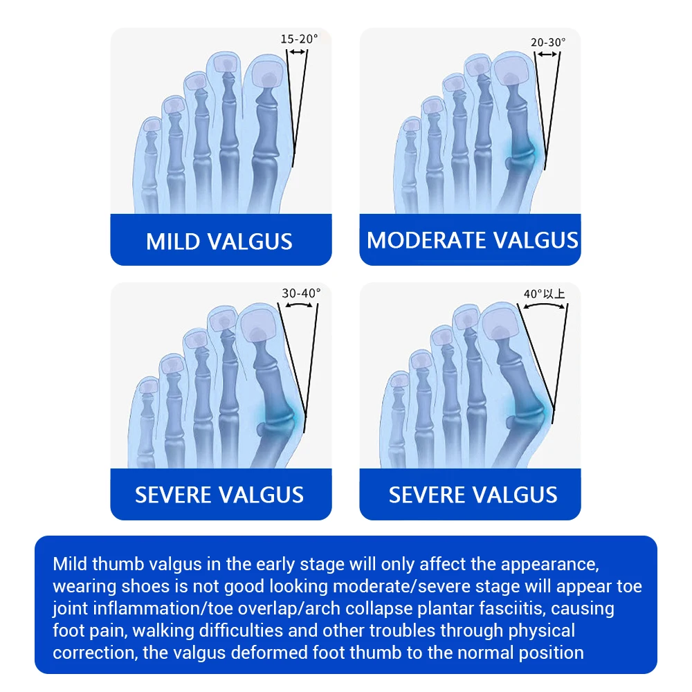 

Bunion Corrector Unisex Valgus Toe Correction Pain Relief Foot Treatments Fat Finger Corrector Angle Adjustable Knob Foot Care