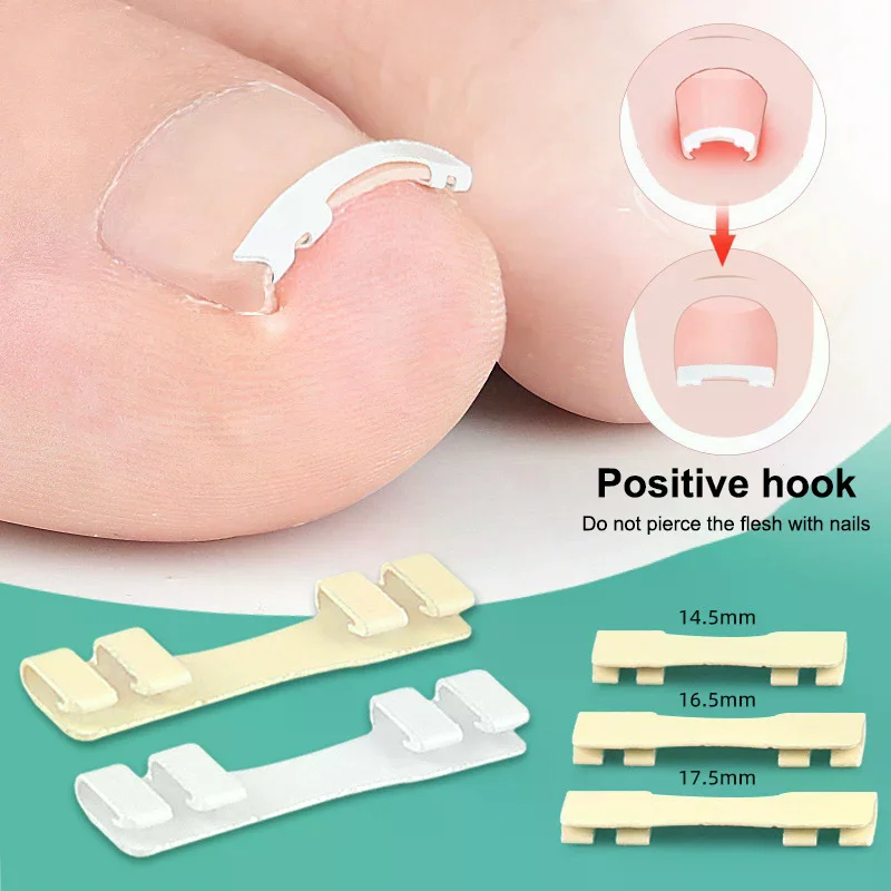 Corrector de uñas encarnadas, herramientas para pedicura, recuperación integrada, tratamiento profesional de uñas encarnadas, cuidado de los pies, 1 Uds.