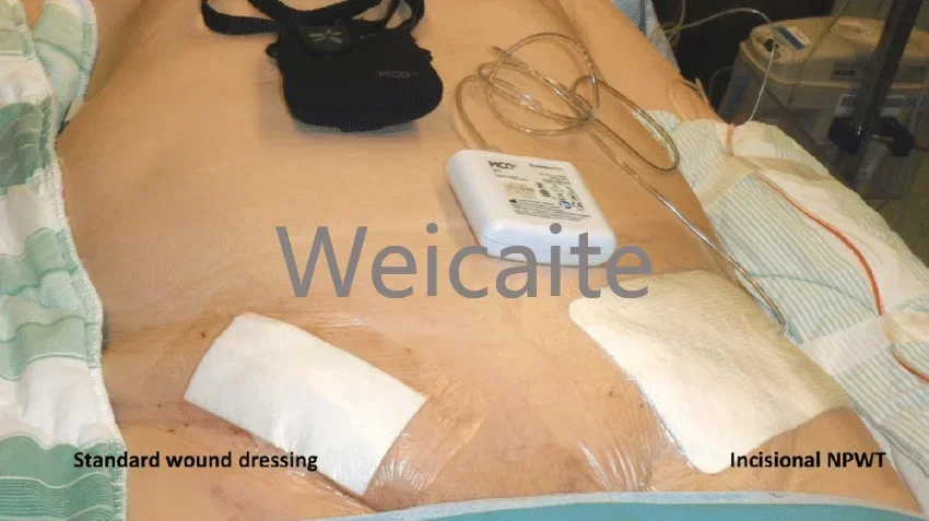 NEW Negative Pressure Wound Therapy System VAC NPWT Device with Dressing Kit Medical Portable