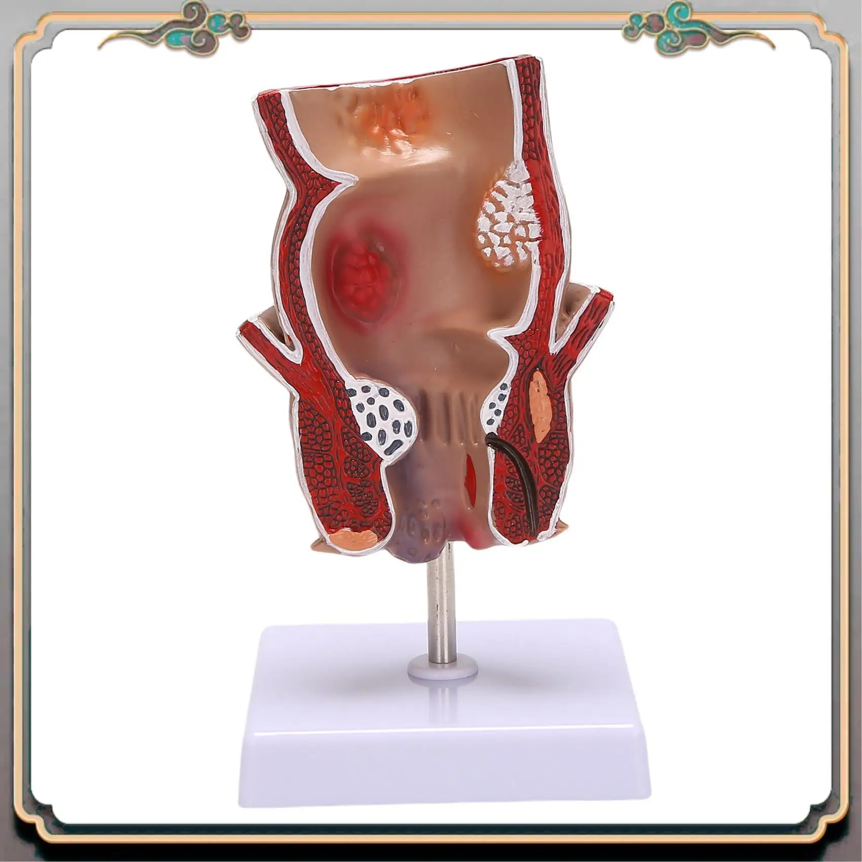 

Durable Anatomy Model Human Rectal Hemorrhoid Lesion Model Hemorrhoid Fistula Fistula Fissure Pathology Teaching Model