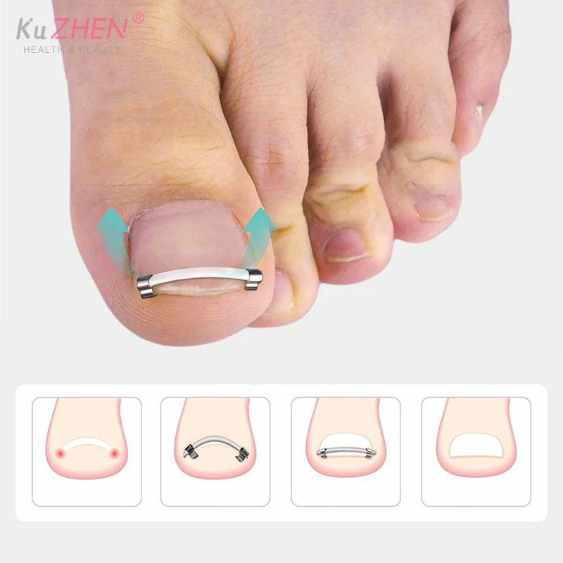 Ingrown Toenail Pedicure Tool Embed Toe Nail Care Straightening Correction Clip Curved Clamp Toenails Correction Tool For Toes