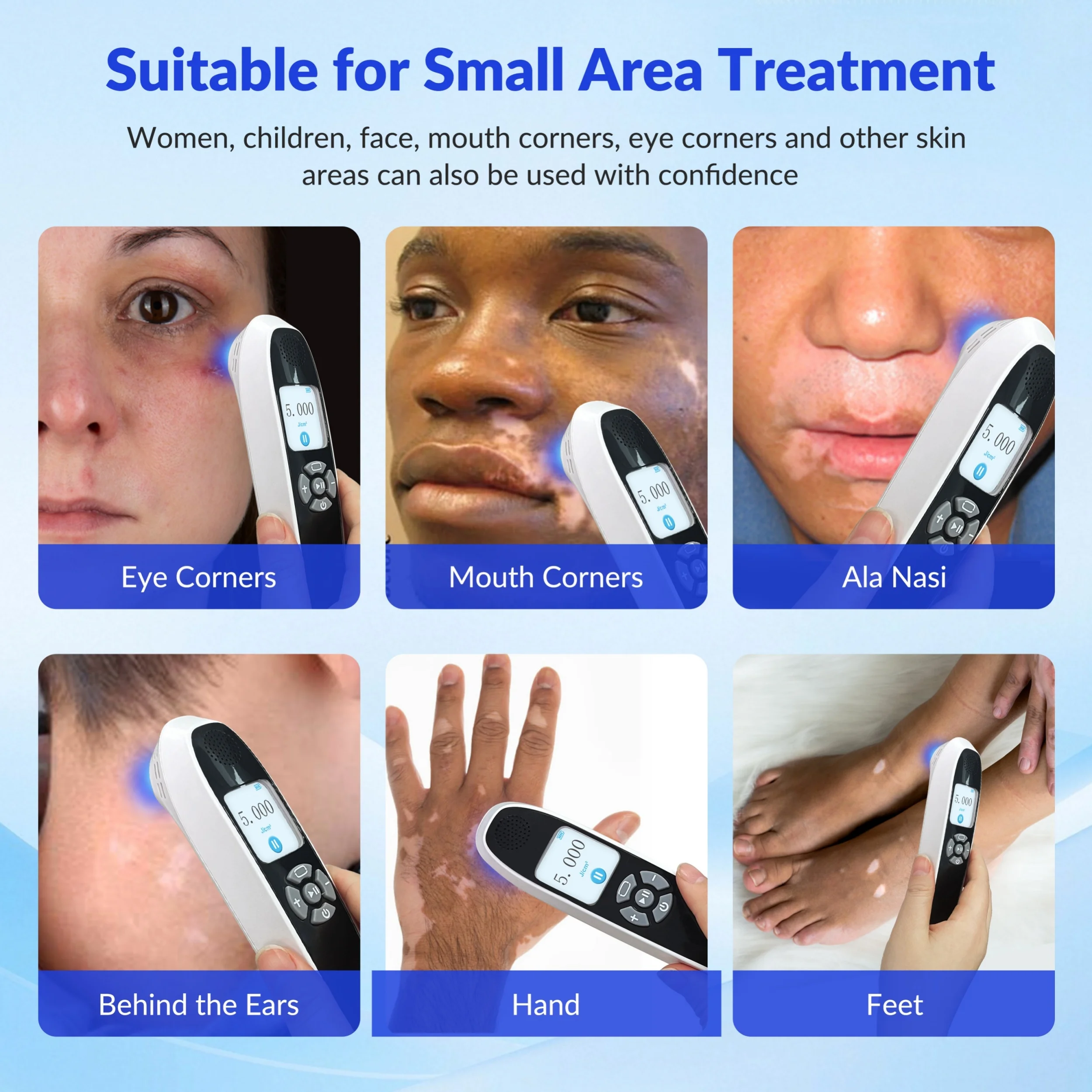 

NEWBest Excimer 308nm UVB Laser Device for Vitiligo Psoriasis Eczema Effective Treatment