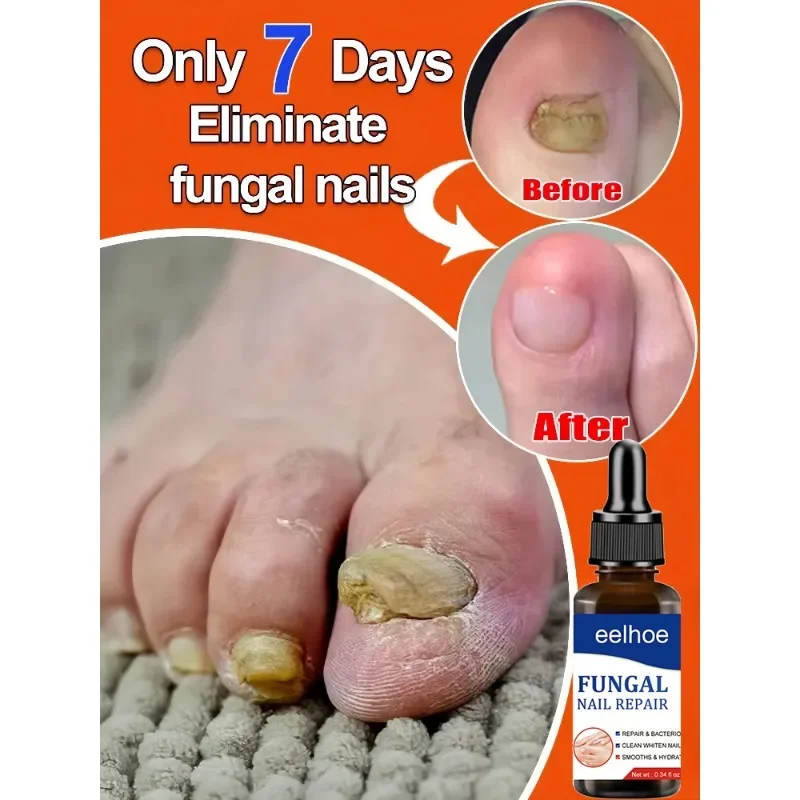 

ᴺᵃⁱˡ ᶠᵘⁿᵍᵘˢ ᵀʳᵉᵃᵗᵐᵉⁿᵗ ᔆᵉʳᵘᵐ