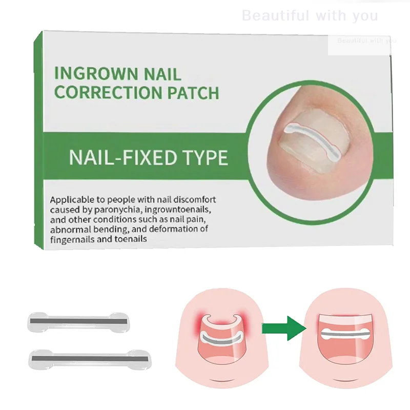 New1Pcs Nail Correctie Stickers Ingegroeide Teennagel Corrector Patches Onzichtbare Hoge Sterkte Extra Patch Paronychia Behandeling
