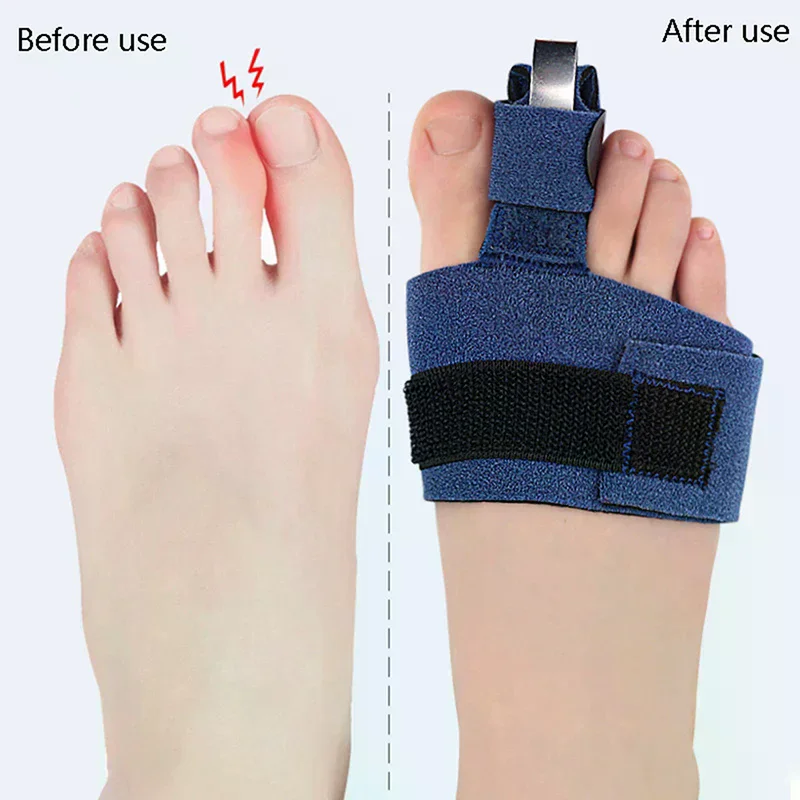 발가락 교정기 발가락 골절 고정기 정형외과용 발뼈 엄지 - Ankle Brace Sock 리뷰 및 가격
