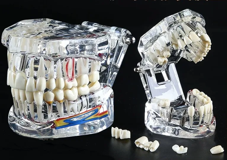 

1pcs Dental restoration model part removable dental mold oral pathology teaching and restoration comprehensive neural