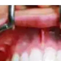 

Dental Orthodontic T Shape Retractor Mouth Gag Opener Retractor Dental Cheek and Lip Retractor Stainless Steel Tools