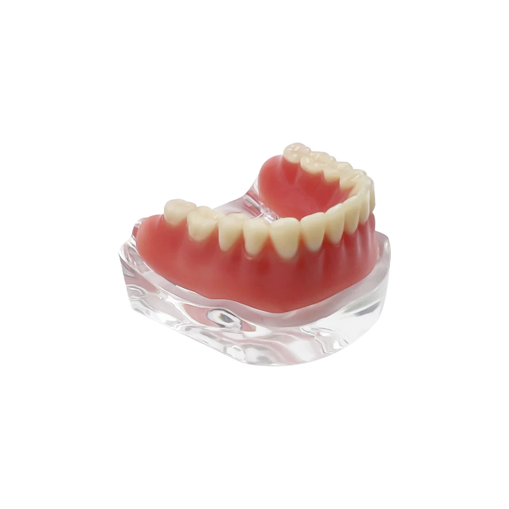 Dental Teeth Model With Implants Lower Jaw M6008 Silver Bar Type Overdenture Model Typodont Restoration Treatment Demo Study