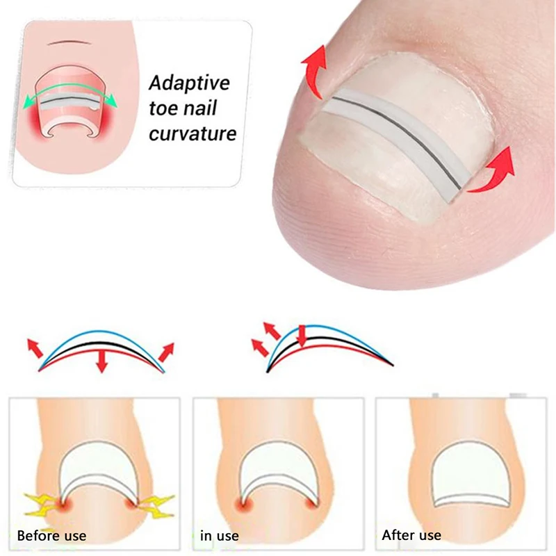 Ingegroeide teennagel Correctie Tool Rechttrekken Clip Brace Ingegroeide teen Nagelbehandeling Elastische patch Sticker Pedicure Tool