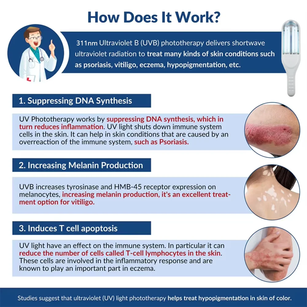 Lampada Uvb Vitiligine Attrezzatura per terapia fisica Lampada per terapia della luce a banda stretta Sorgente luminosa medica Lampada per terapia ultravioletta da 311 nm