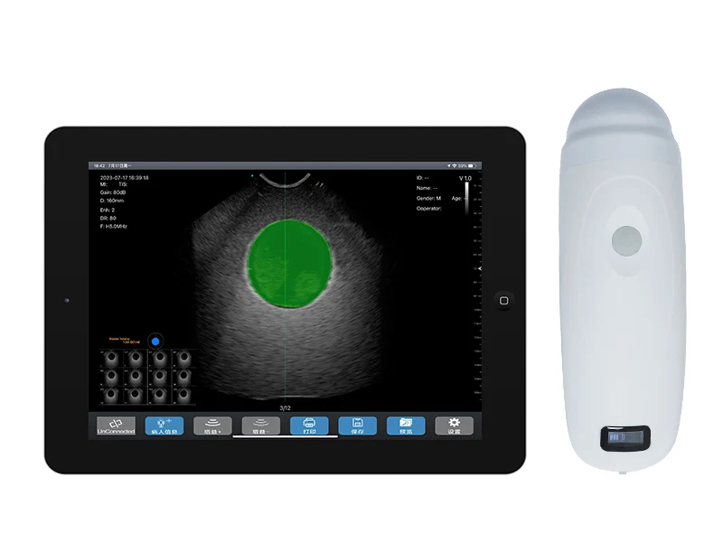 4D Wireless Probe Bladder Ultrasound Scanner Sonostar Bprobe-5 New Version