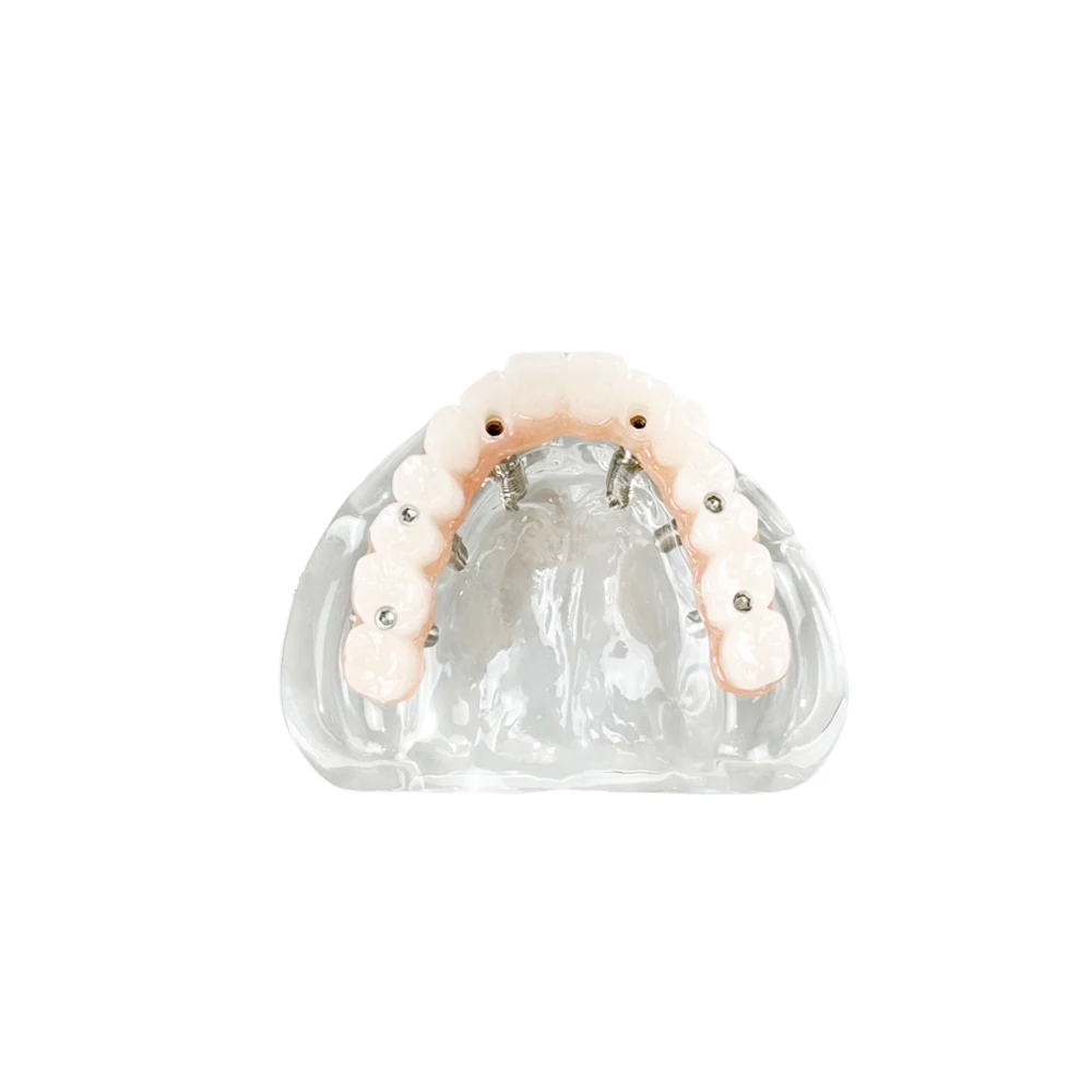 

Upper Jaw Dental Implant Model 6 Implants Maxillary Overdenture Teeth Model For Training Practice Education Studying Teaching