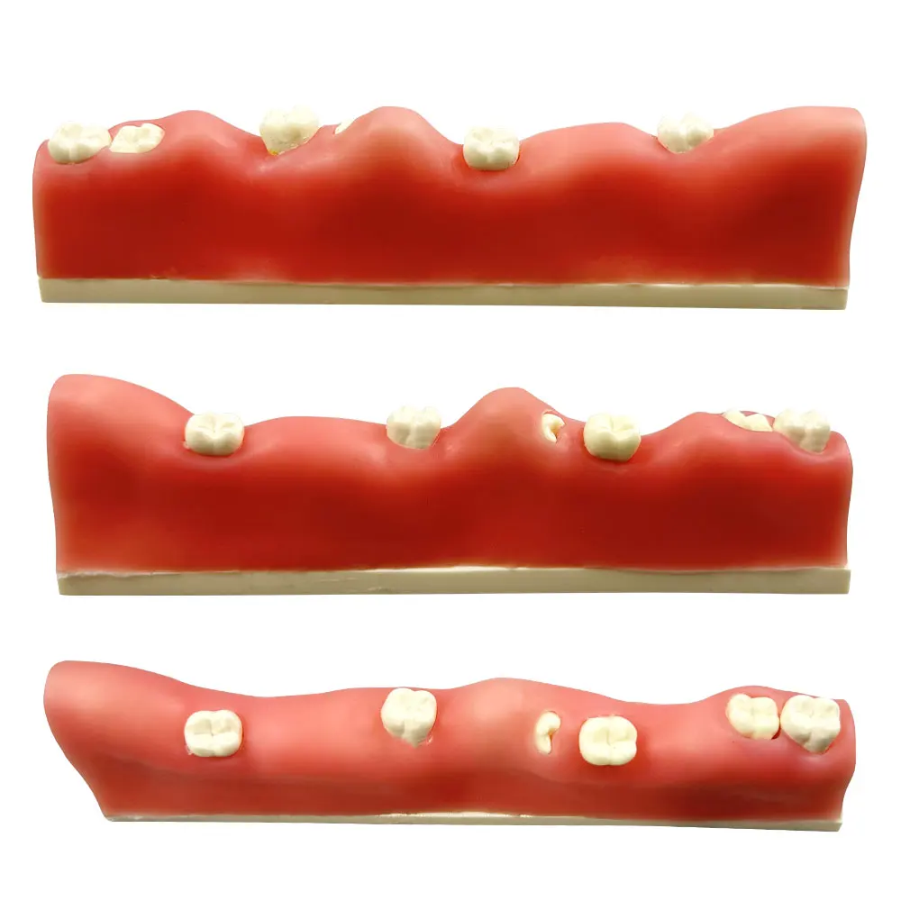 Dental Impacted Tooth Model Unerupted Tooth Extraction Practice Training Model Resin Wisdom Teeth For Dentistry Teaching Study