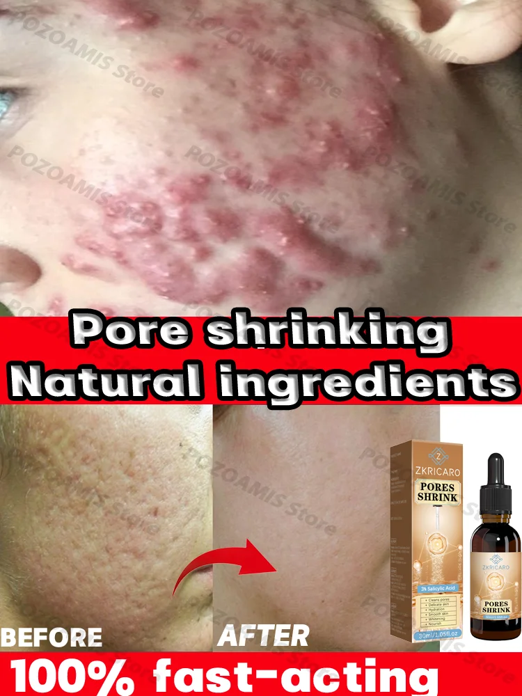 

Shrink pores to avoid strawberry nose blackheads and enlarged pores