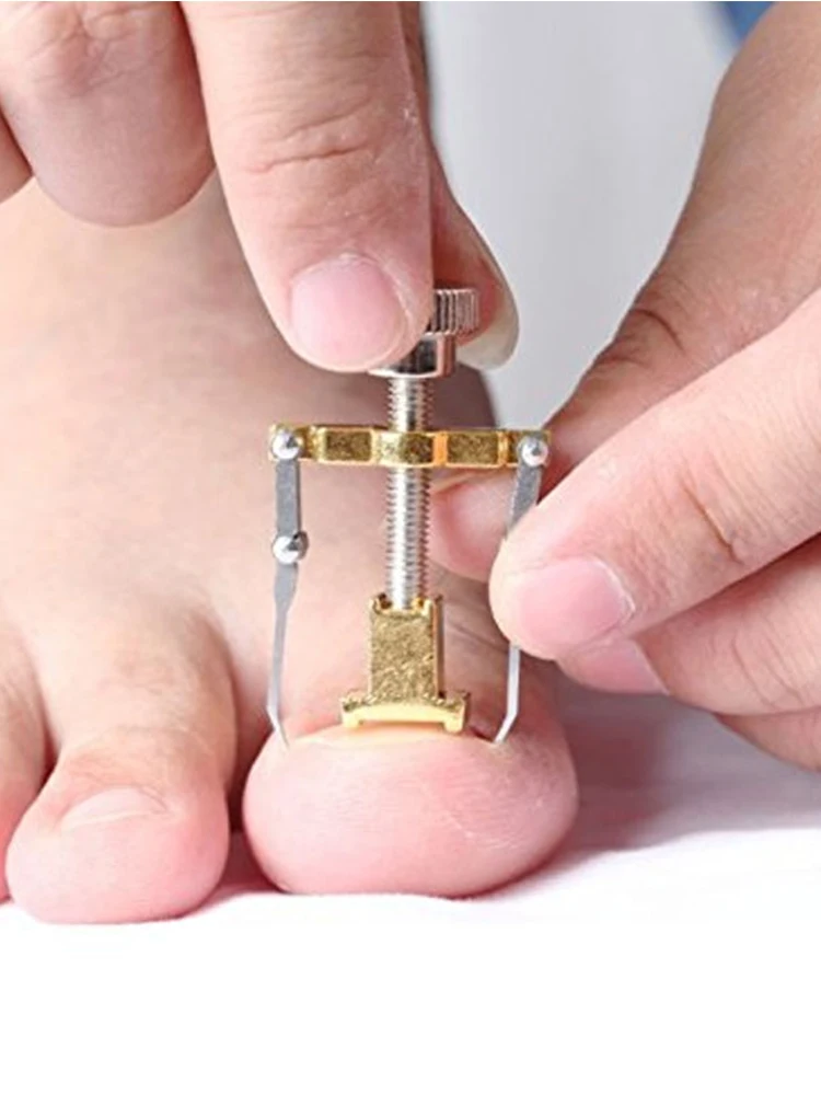 Correction of Paronychia with Toe Nail Correction Bracket for Treatment of Toe and Toe Care with Toe Fixator