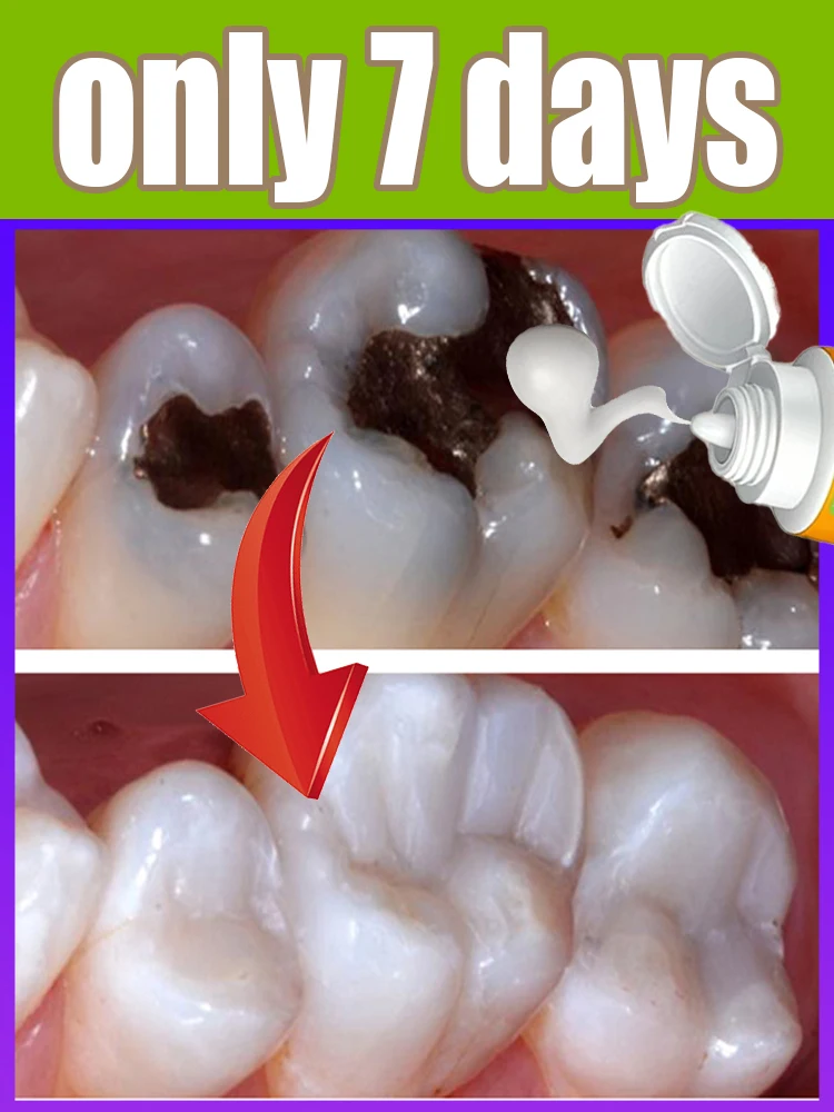 Deep anti-caries toothpaste: cleans plaque between teeth