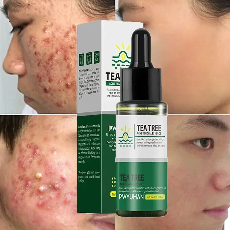 

Tea Tree Acne Removal Serum Antil-Acne Fade Acne Marks Facial Serum Shrink Pore Treatment Acne Cleaning Repair Smooth Skin Care