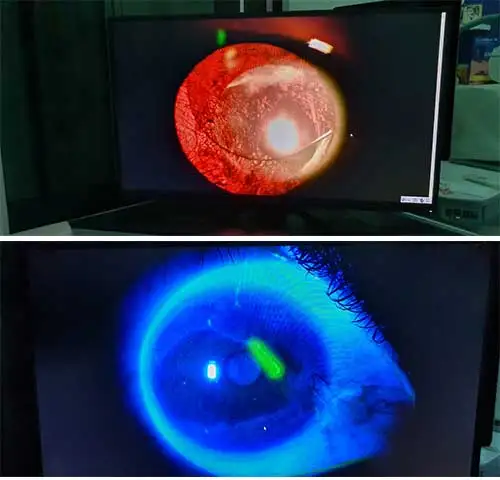 Ophthalmic Equipment Slit Lamp Imaging System Module Phoenix for Computers to Take Pictures