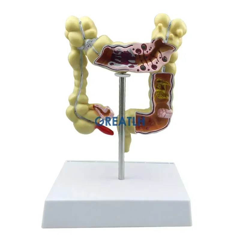 GREATLH Pathological Anatomy Colon Diseases Intestine Medical Human Colorectal Lesion Model Student Studying Learning Tool