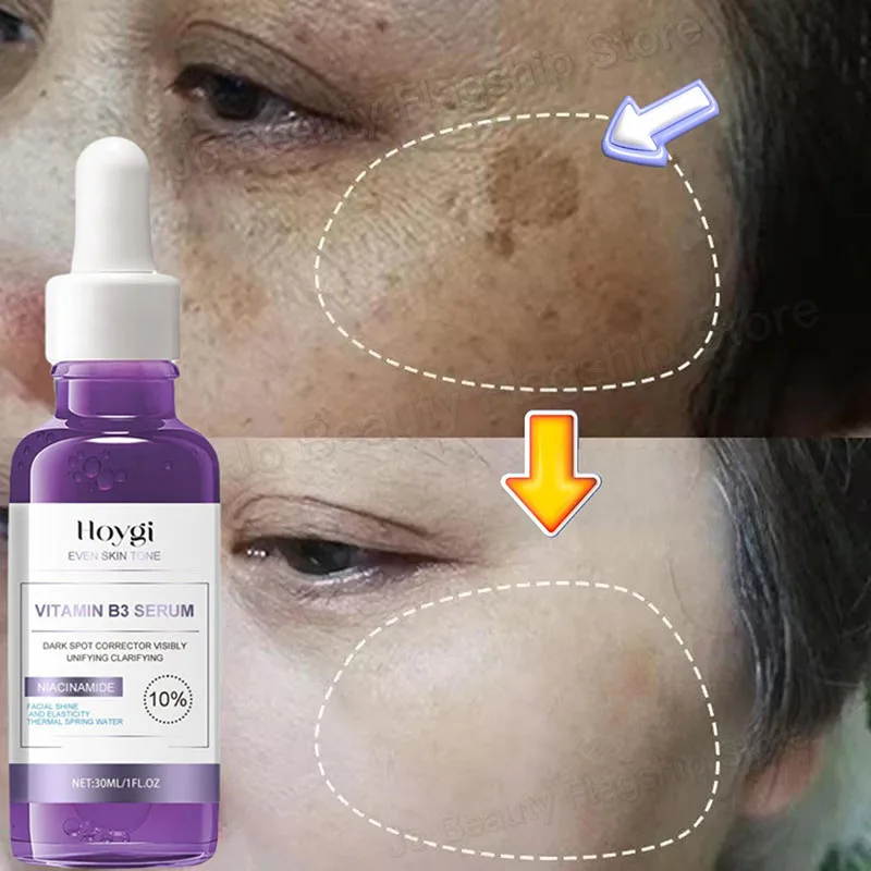 Dark Spots Remover Whitening Serum Face Freckle Melanin Correcting Anti Pigmentation Brighten Beauty Korean Day Night Skin Care