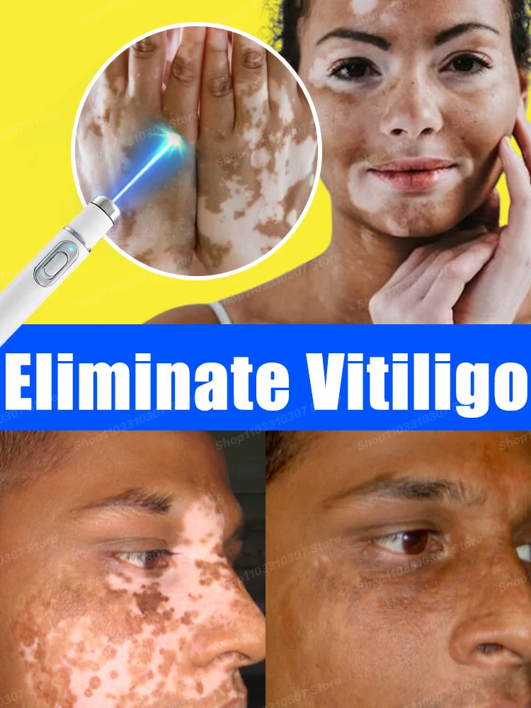 

Vitiligo Laser