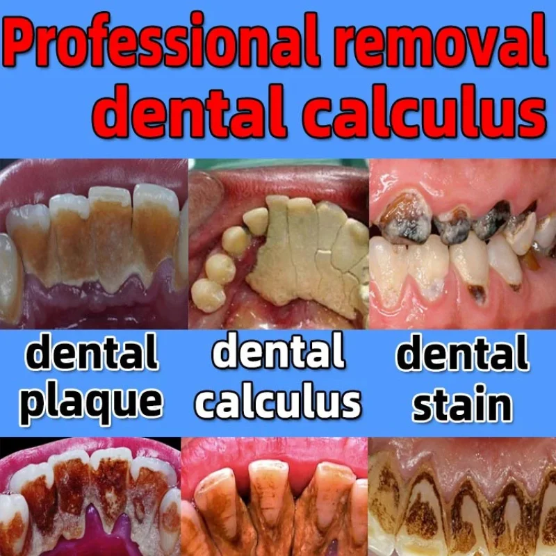 Remove Yellow Teeth Toothpaste Dental Calculus Removal Mouth Odour Bad Breath Preventing Periodontitis Fluoride Toothpaste