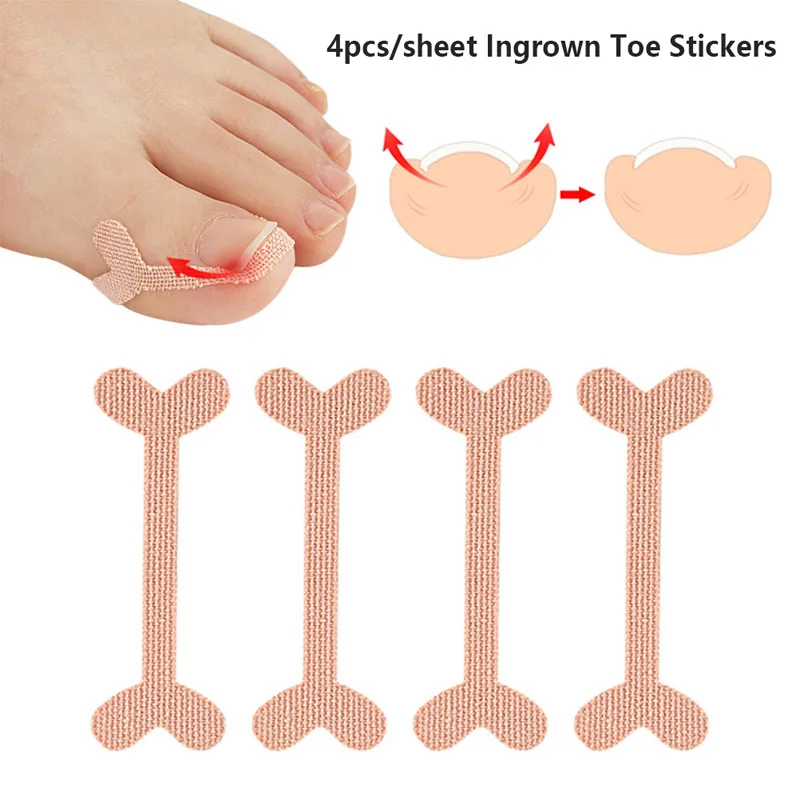 

Improve Toe Embedded Nail Groove Relief Paste And Correct Nail Curling