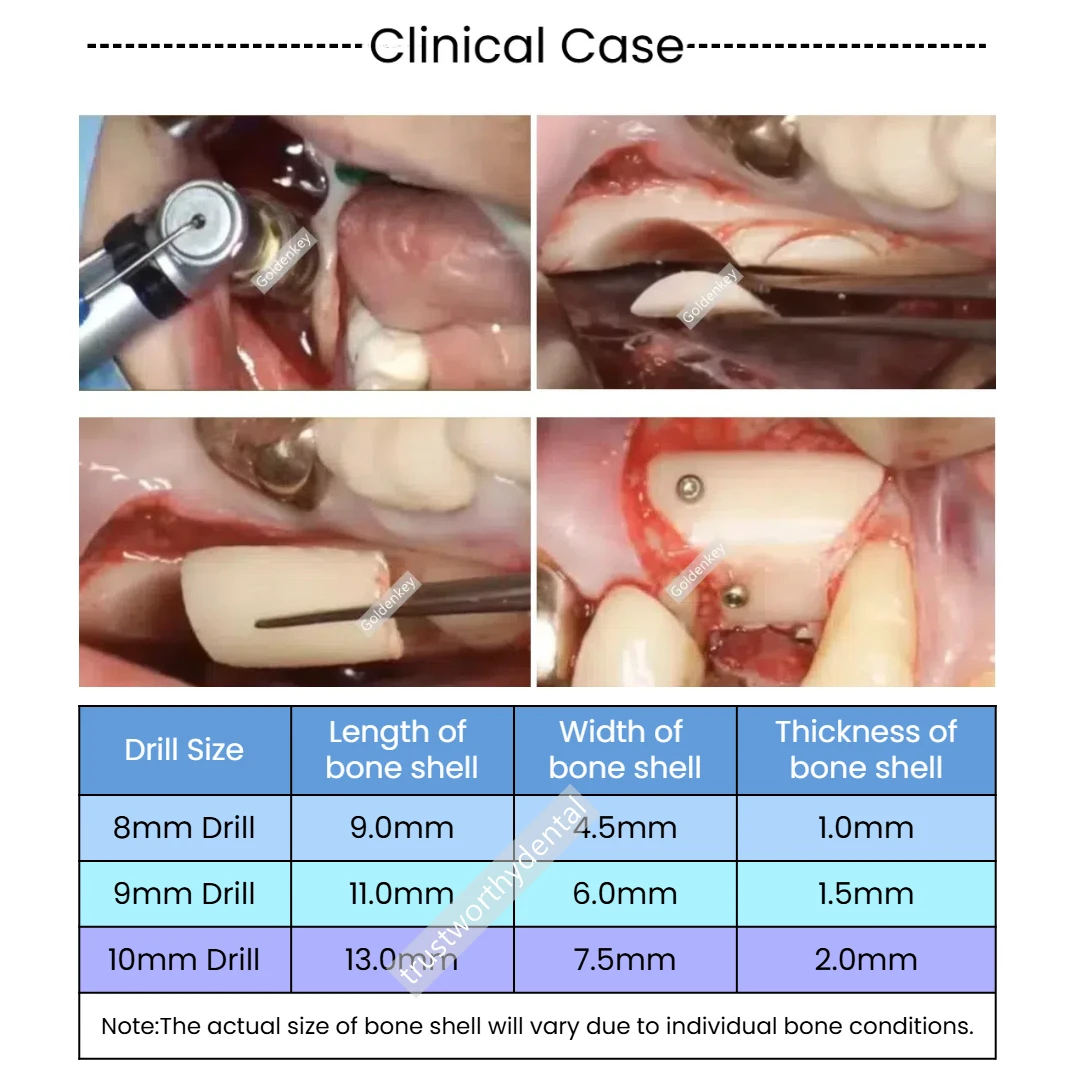 Dental Easy Bone Collector Semilunar Technique GBR SLT Drill Implant Semilunar Shell Bone Argumentation Harvest Half moon EBC