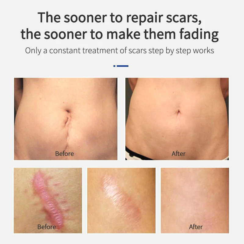 MSLAM  Scar Repair Cream Scar Gel, Acne, Burns, Surgery, C-section and Keloid Treatment Repairs Injured Skin Promotes Cell Regen