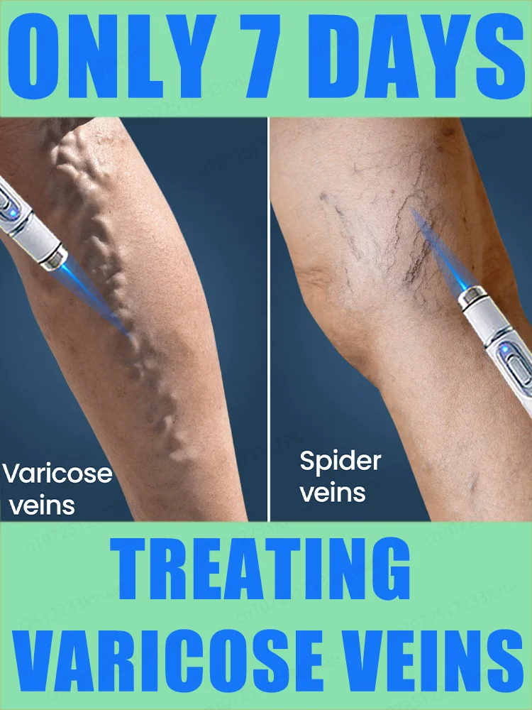 

Blue Light Pen Solve Varicose Veins, Hot Sale Leg Care Tools Remove Spider Legs In 7 Days