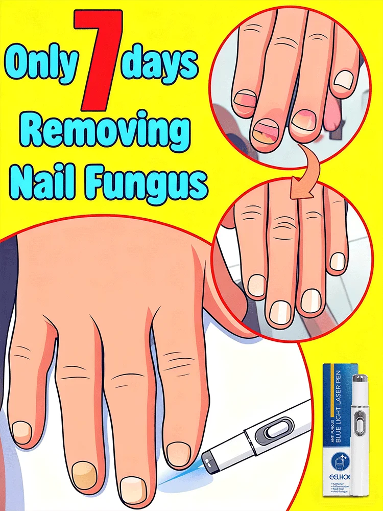 

Fungus nail laser pointer helps to get rid of onychomycosis gray nail Painless and long-lasting sterilization anti-recurrence