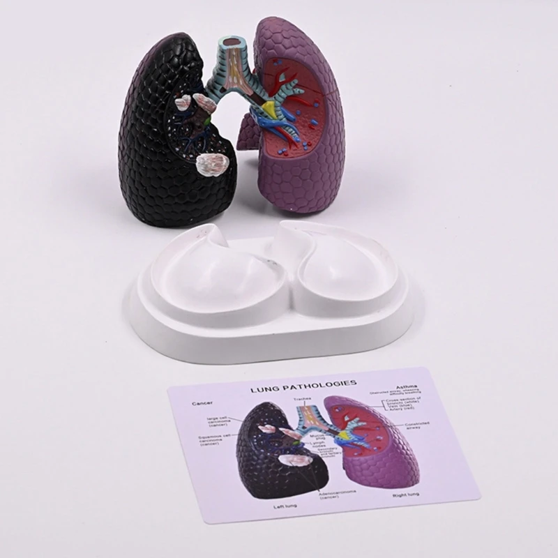 

Anatomical Pathological Lung Model Normal and Pathological Lung Anatomy Model for Teaching Research Clinical Settings D2RC