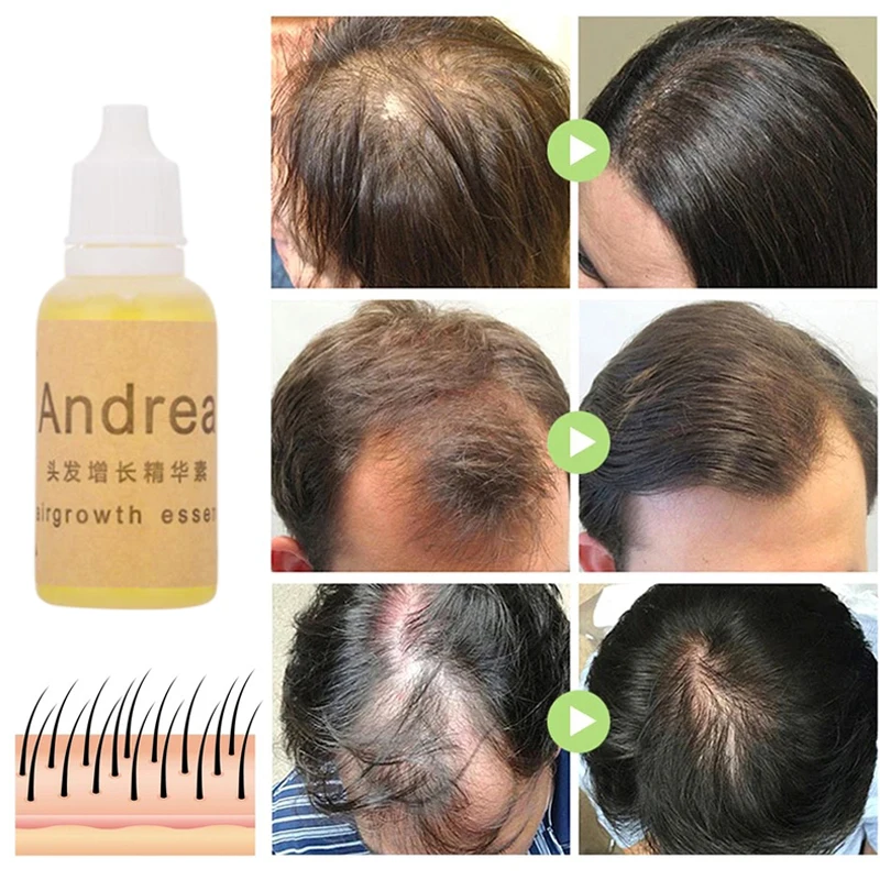 3/5 قطعة أندريا زيت نمو الشعر جوهر سماكة لنمو الشعر مصل تساقط الشعر المنتج 100% مستخلص نباتي طبيعي سائل 20 مللي #1